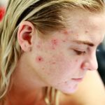 Dit zijn de 3 meest voorkomende oorzaken van acne