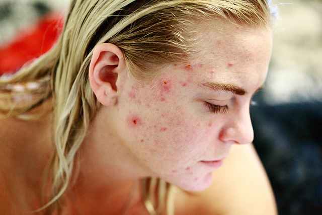 Dit zijn de 3 meest voorkomende oorzaken van acne